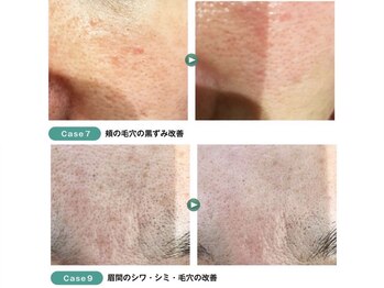 ディオーネ 西船橋駅前店(Dione)/幹細胞導入◇Before After 3