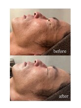 エクラ(ECLAT)/クールビタミンでシワ改善！