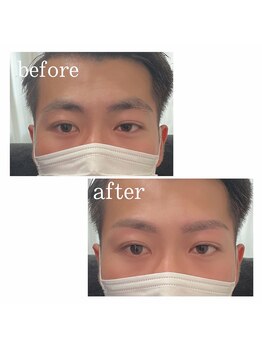 リンク(LINK)/眉毛症例