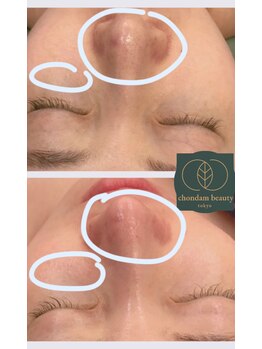 チョンダムビューティー(chondam beauty)/ディープな毛穴汚れにはこれ！
