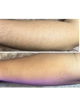 ジョルフ サロン オリジナル(JOLF salon original)/夏になる前にオススメ！腕脱毛！