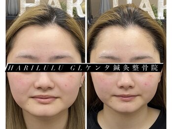 ハリルル 併設 GLケンタ鍼灸整骨院(HARILULU)/ハイパーナイフとの組み合わせ！