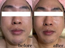 エステサロン ジョアアンジェ(joie ange)/レッドショット1回