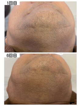 アイアイくらぶ美容部/ひげ脱毛