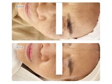 オービーエム 博多阪急店(O.B.M)/【70代シミケア症例】