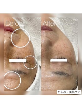 イリス(Iris)の写真/ほうれい線・たるみに◎高周波たるみケアでリフトアップ！フェイスラインすっきり！理想の小顔へ導きます♪