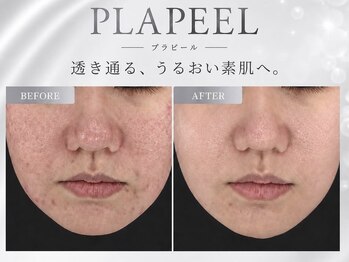 ビジュー(BIJOU)の写真/韓国に行かなくても同じ施術が受けられる！圧倒的実績数No.1♪超最新韓国発"ララピール"導入サロン！