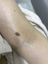 ナノハナ/鹿沼市本格全身脱毛ナノハナ