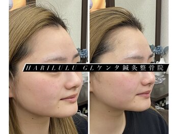 ハリルル 併設 GLケンタ鍼灸整骨院(HARILULU)/ハイパーナイフ×美容鍼