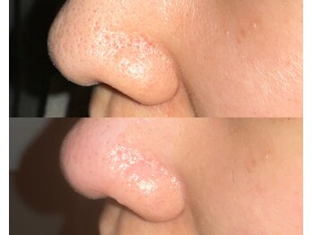 ル シーニュ/毛穴エクストラクション