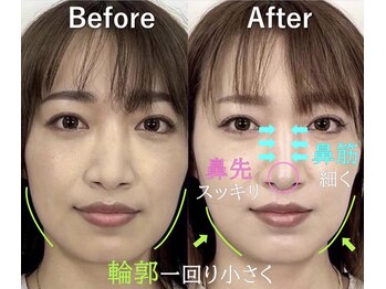 ラプリエイル 千葉店(Raplit aile)/ 隆鼻+輪郭矯正40分