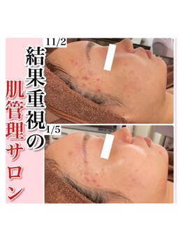 ホワイトアクア 四日市店(WHITE AQUA)/結果重視サロン/肌質改善