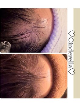 シンデレラ メンズ(Cinderella)/育毛促進コース