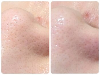 トータルビューティ ノイド(Noid)/毛穴洗浄　小鼻のみ