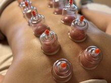 ガチガチの背中にカッピングを無料でおつけできます