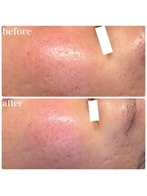 ディオーネ 春日井勝川店(Dione)/ヒト幹細胞毛穴洗浄