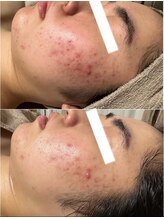 エステ リラクゼーションサロン(more)/赤ら顔・ニキビ改善