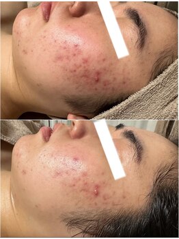 エステ リラクゼーションサロン(more)/赤ら顔・ニキビ改善