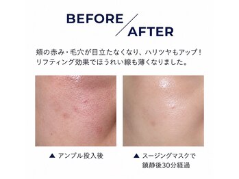 エルビウ(ELBIU)の写真/渡韓いらず《エステ版ポテンツァで本格韓国肌管理》毛穴、ニキビ、ハリ、ツヤ様々なお肌悩みにアプローチ♪