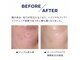 エルビウ(ELBIU)の写真/渡韓いらず《エステ版ポテンツァで本格韓国肌管理》毛穴、ニキビ、ハリ、ツヤ様々なお肌悩みにアプローチ♪