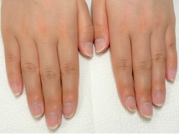 インテグラル 水戸店(integral)/☆自爪回復コース改善例・after