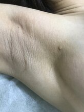 ナノハナ/鹿沼市本格全身脱毛ナノハナ