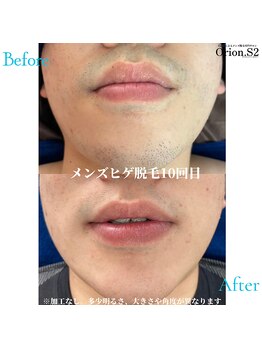 オリオンドットエスツー(Orion.S2)/【Before→After】