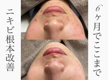 何をしても改善しなかった肌も6カ月でここまで！
