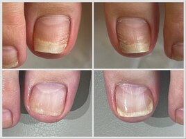 【巻き爪】不快な痛みはお任せ