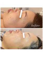 ラディエンス 多治見店/マーメイドセルトリートメント