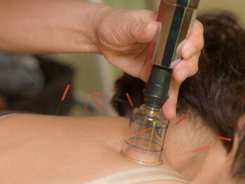 はるもにあ/鍼灸×カッピング《肩》