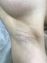 ナノハナ/鹿沼市本格全身脱毛ナノハナ