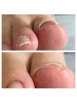 ミミ(mimi)/巻き爪ケア