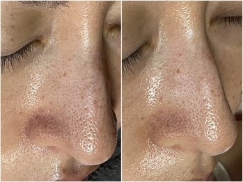 スパークル/フェイシャル/毛穴/毛穴洗浄