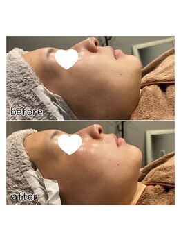 アデル 久留米(ADEL)/《全顔》フェイシャルワックス