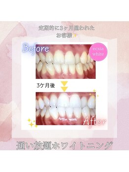 エクシアホワイトニング 明石店/ビフォーアフター