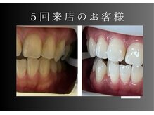 エランホワイトニング 一社店/症例写真