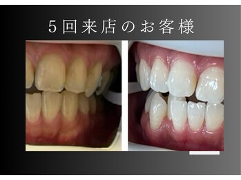 エランホワイトニング 一社店/症例写真