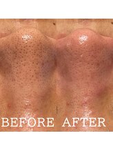 アマリリス(Amaryllis)/毛穴洗浄before/after