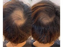 シンデレラ メンズ(Cinderella)/育毛促進コース