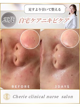 シェリー(Cherie)/施術なし！酒さ×ニキビケア