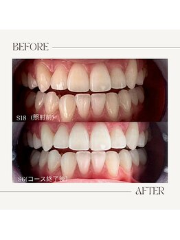 ホワイトニングビューティー 鯖江店(WHITENING BEAUTY)/１ヶ月お試しホワイトニング