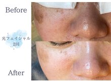 ディアスマイル(Dear.smile)/光フェイシャル2回