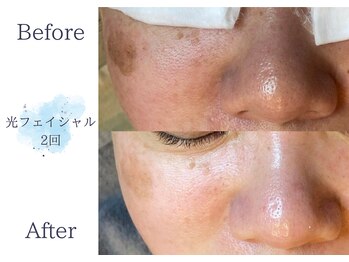 ディアスマイル(Dear.smile)/光フェイシャル2回