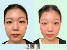 ナチュラルパーフェクトフェイス 新宿/６回目フェイスライン/新宿小顔