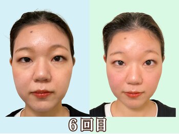 ナチュラルパーフェクトフェイス 新宿/６回目フェイスライン/新宿小顔