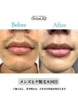オリオンドットエスツー(Orion.S2)/【Before→After】