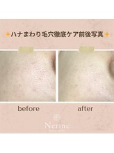 ネリネ(Nerine)/ハナまわり毛穴徹底ケア前後写真