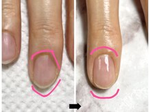 ブルヴェール(Bleu vert)/補強ケアコース4回