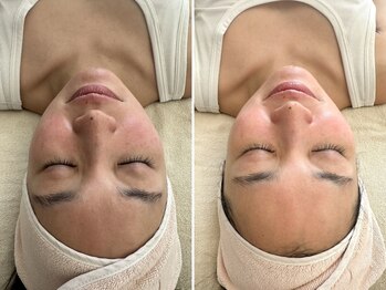 マヴィ くずは店(MavY.)/小顔リフトアップ